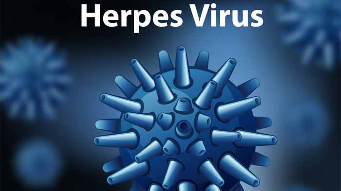 Cara Mengobati Virus Herpes